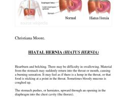 Apa Itu Hernia Hiatus? Ini Penjelasan yang Sering Disalahpahami!