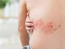 Apakah Herpes Zoster Menular? Ini Fakta Penting!
